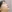 鼻尖形成術（自家軟骨移植） — マスト美容外科クリニック