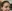 lower blepharoplasty (under-eye bag removal with fat repositioning) — Leaf Plastic Surgery Clinic