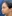 Double chin liposuction (submental liposuction) — Jewelry Plastic Surgery Clinic