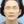 Ultracol (PDO microsphere collagen stimulator injection) — before · J.Fill Clinic - Gangnam Branch