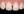 Composite resin filling — before · Yonsei Good Day Dental Clinic - Suseo Branch