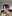 Nasal Tip Plasty with Autologous Cartilage — Tianna Plastic Surgery Clinic
