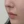 โบท็อกซ์ร่นร่องริมฝีปาก (Lip Flip ทำให้ร่องใต้จมูกดูสั้นลง) — ก่อนทำ (7วัน) · คลินิก Younme