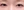 Eyelid filler (upper eyelid hollowing correction) — before · Sinsa Cerea Clinic