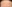 額縮小術（生え際下げ・ヘアライン下降術） — バタン美容外科クリニック