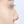 Nasal osteotomy (nasal bone narrowing) — before (7days) · Pop Plastic Surgery Clinic