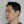Density Lifting (RF skin tightening / lifting) — before · Ripain Clinic