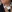 Double chin liposuction (submental liposuction) — Pladen Plastic Surgery Clinic
