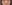 糸リフト（スレッドリフト） — ミケイ美容外科