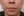 JUVGEN (autologous dermal regeneration / collagen-induction injection) — after (14days) · Saeroun Plastic Surgery