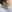 ดูดไขมันใต้คาง (เหนียง) — คลินิกฟิตติ้ง