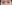 Lower Eyelid Fat Repositioning (transconjunctival) — Uri Plastic Surgery Clinic