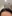 額縮小術（生え際下げ・ヘアライン下降術） — 風が吹く日にも美容外科クリニック