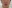 Lip lift (philtrum reduction) — Ua Plastic Surgery Clinic