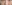 裏ハムラ法（経結膜的眼窩脂肪移動術） — アンド美容外科クリニック