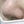acne scar subcision / regenerative needling — after (120days) · Rodam Korean Medicine Clinic - Jamsil Branch