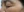 Surfect Lifting (4MHz monopolar RF lifting) — before (7days) · Le Shine Clinic