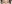 裏ハムラ法（経結膜的眼窩脂肪移動術） — ウィバース美容外科クリニック