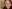 Lower Eyelid Fat Repositioning (transconjunctival) — Hershey Plastic Surgery Clinic