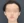 two-jaw surgery (bimaxillary orthognathic surgery) — before (90days) · ReFace Dental Hospital