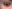 Rejuran i (Rejuran Eye) — polynucleotide (PN) under-eye skin booster — Ruby Clinic