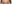 Ptosis Correction (levator surgery / eye-shape correction) — Thank You Plastic Surgery