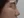 Nasal tip augmentation with implant — after (7days) · The Ollim Plastic Surgery Clinic
