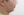 ตัดไขมันกระพุ้งแก้ม — ก่อนทำ (9วัน) · ไอรูมิ ศัลยกรรมพลาสติก
