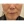 ฉีดไขมันตัวเองทั้งใบหน้า (ศัลยกรรมเติมไขมันใบหน้า) — ก่อนทำ (14วัน) · ซุนพลัสศัลยกรรมพลาสติก