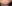 唇のヒアルロン酸注入（リップヒアルロン酸） — ロリポップ美容外科クリニック