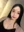 JUVÉDERM VOLITE / SKINVIVE (สกินบูสเตอร์ไฮยาลูรอน) — หลังทำ (14วัน) · มิลค์กี้คลินิก
