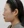ฉีดสลายไขมันหน้า (เมโสแฟตแก้ม) — หลังทำ · ศูนย์ศัลยกรรม Zero - สาขาชินซา