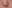 Bulbous nose correction (surgical nasal tip reduction) — Girin Plastic Surgery Clinic