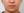 JUVGEN (autologous dermal regeneration / collagen-induction injection) — before (14days) · Saeroun Plastic Surgery