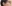 裏ハムラ法（経結膜的眼窩脂肪移動術） — プレジャー美容外科クリニック