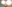 団子鼻修正（鼻尖縮小術） — ビギン美容外科クリニック