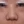 ผ่าตัดแก้ไขผนังกั้นช่องจมูกคด (Septoplasty) — ก่อนทำ (14วัน) · คลินิกโคบิจู