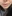 Lip filler (lip augmentation with HA) — Lollipop Plastic Surgery Clinic