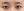 incisional double eyelid surgery — before (7days) · iLumi Plastic Surgery Clinic