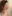 フェイスリフト（切開リフト） — ザフィックス美容外科クリニック