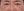 lower blepharoplasty (under-eye bag removal with fat repositioning) — after (7days) · Steady Plastic Surgery Clinic