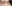 裏ハムラ法（経結膜的眼窩脂肪移動術） — アイフィット美容外科クリニック
