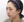 Paranasal (nasal base) augmentation with implant — before (50days) · iLumi Plastic Surgery Clinic