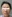 Facelift (rhytidectomy) — DM Plastic Surgery Clinic