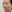 Nasal tip surgery (tipplasty) — B&Young Clinic