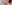 団子鼻修正（鼻尖縮小術） — ウィバース美容外科クリニック