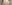 二の腕の脂肪溶解注射 — ロリポップ美容外科クリニック