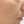 PRP skin rejuvenation (platelet-rich plasma therapy) — before (21days) · Only Lift Clinic