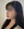 顴骨肉毒桿菌注射 — 術後 (7天) · U-Line醫美診所