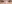 裏ハムラ法（経結膜的眼窩脂肪移動術） — ファクト美容外科クリニック